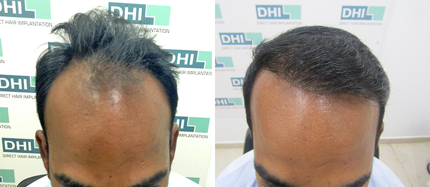 DHI before & after hair transplant results